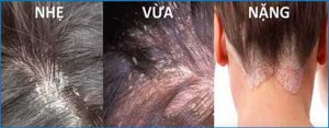 Nấm da đầu gây cho người bệnh khó chịu và gây mất thẩm mỹ 