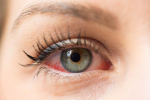 Ngứa mắt dị ứng là hiện tượng gì, cách chữa trị